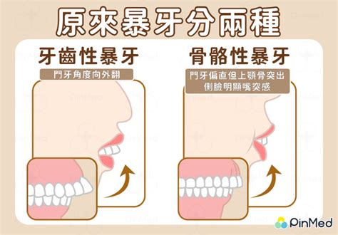 門牙暴牙面相|怎樣從門牙看面相